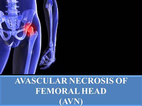 What Is Avascular Necrosis?